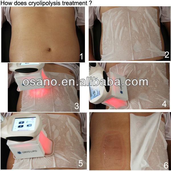 Professional Cryotherapy Cryolipolisis Velashape Cellulite Reduction 