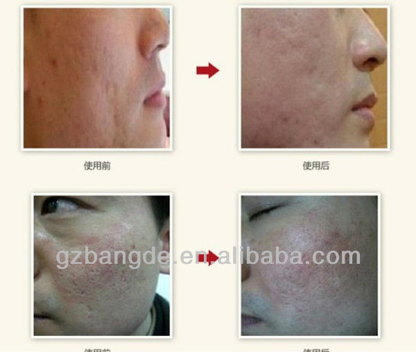 Home use electric microneedling dermaroller for skin care beauty 