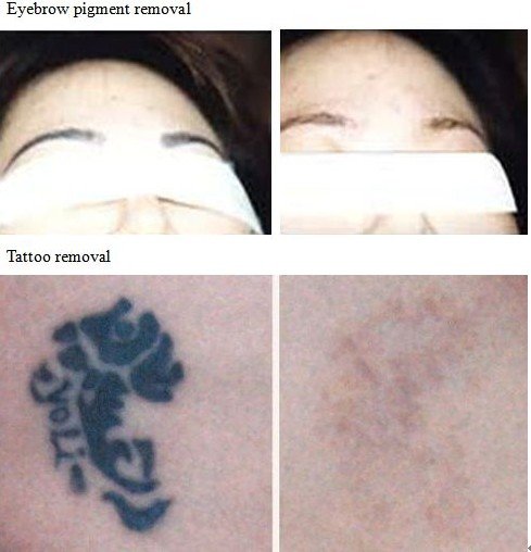 Pin Review Article Laser Tattoo Removal A Kathryn M Kent Md On Picture