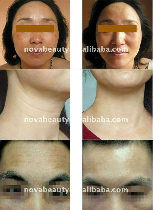 2016 New NV-07D,4 in 1 Diamond Dermabrasion (CE approval)