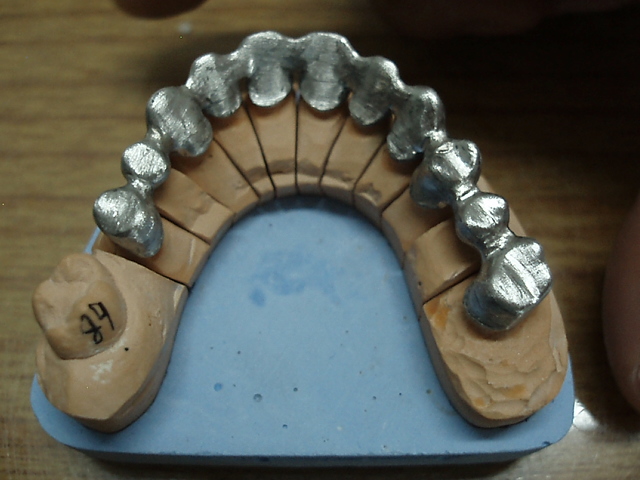 Dental Metal