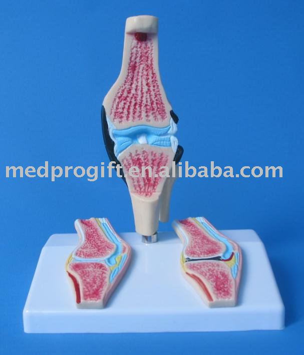 arthritis knee. Rheumatoid Arthritis Knee