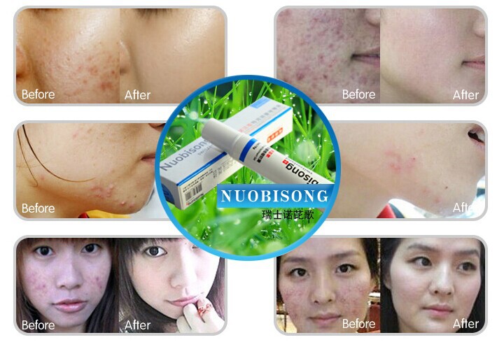 i00.i.aliimg.com/wsphoto/v0/1886970472_1/Nuobisong-Specific-Acne-Cream-Acne-Treatment-Blackhead-Spot-Removing-Pores-Whitening-Moisturizer-Sensitive-skin-care-face.jpg