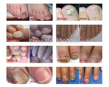 AFY herbal regeneration Nail fungus treatment gel nail polish TOE fungal nail art care For nail