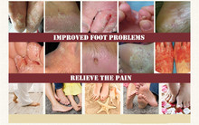 Beriberi Spray Remove Peeling Itchy Athlete s Foot Odor Erosion Blister Ointment Sterilization Feet Hand Care