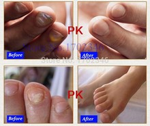 Fungal Nail Treatment Essence Nail and Foot Whitening Toe Nail Fungus Removal Feet Care 
