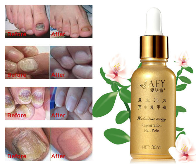 Fungus Nails Polish Cuticle Oil For Removal Revitalizer Nail Treatment Onychomycosis Feet Care Nails Growth And