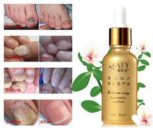 Fungus Nails Polish Cuticle Oil For Removal Revitalizer Nail Treatment Onychomycosis Feet Care Nails Growth And Nail Repair 2015
