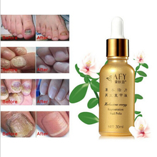 AFY 2pcs/lot Fungal Nail Treatment Essence Nail and Foot Whitening Toe Nail Fungus Chinese medicine  Removal Feet Care Nail Gel